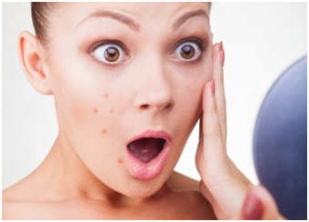 CÁC NGUYÊN NHÂN GÂY RA MỤN 